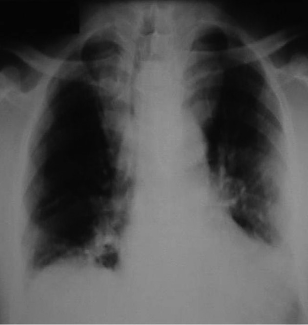 Coexistence of Obstructive Sleep Apnea and Superior Vena Cava Syndromes Due to Substernal Goitre in a Patient With Respiratory Failure: A Case Report.