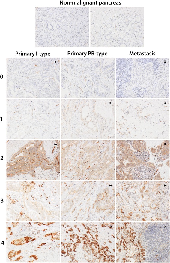 Prognostic and predictive significance of podocalyxin-like protein expression in pancreatic and periampullary adenocarcinoma.