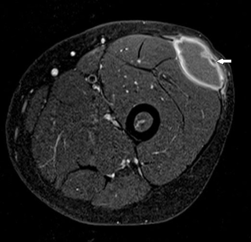 Isolated Cysticercosis Lump over Thigh in a Child.