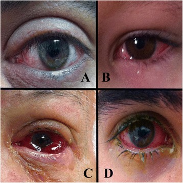 Clinical and public health management of conjunctivitis in the Israel Defense Forces.