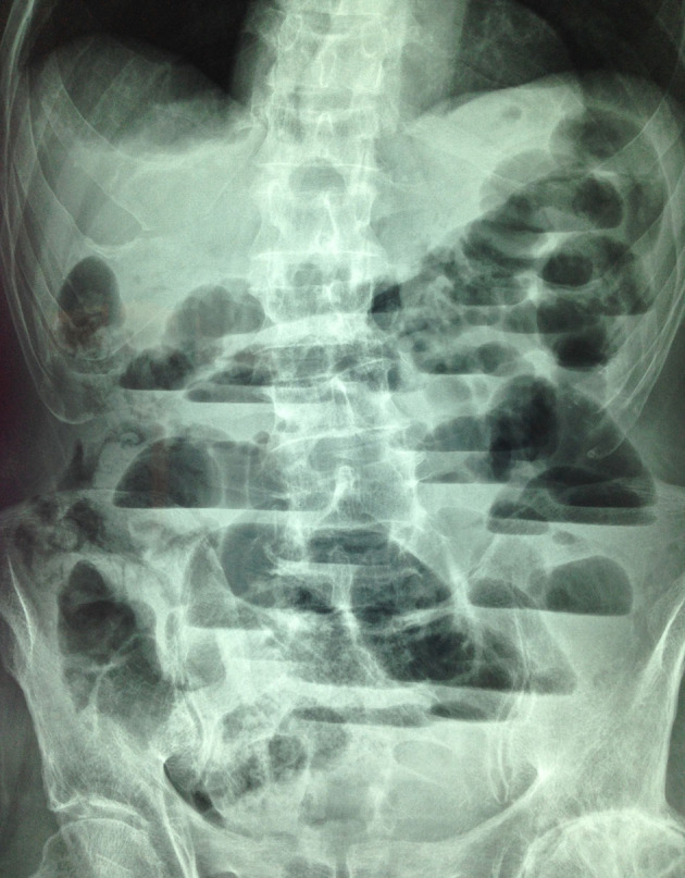 Intestinal Obstruction Due to Idiopathic Sclerosing Encapsulating Peritonitis: A Case Report.