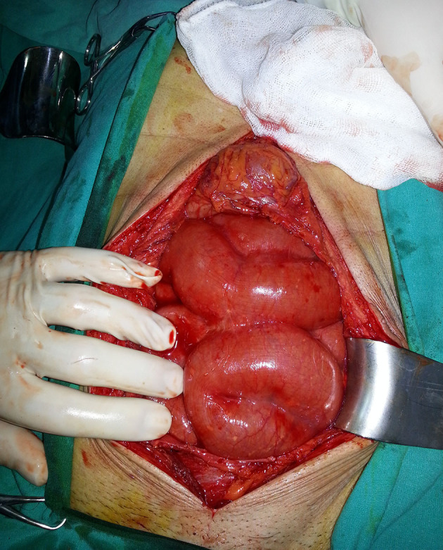 Intestinal Obstruction Due to Idiopathic Sclerosing Encapsulating Peritonitis: A Case Report.