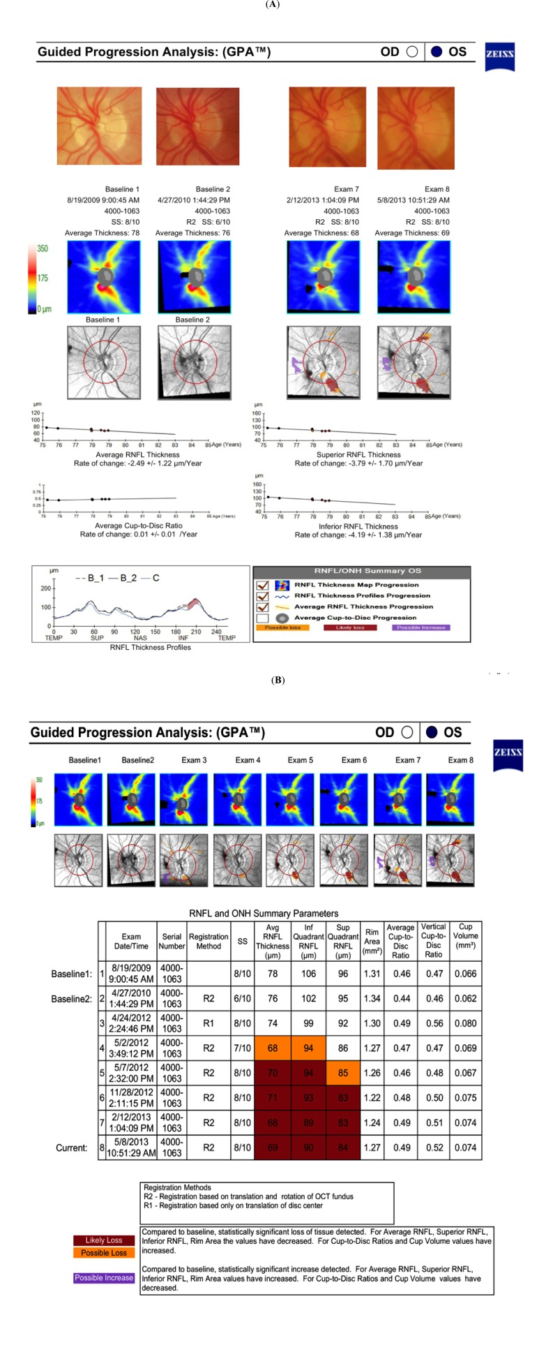 The Use of Spectral-Domain Optical Coherence Tomography to Detect Glaucoma Progression.