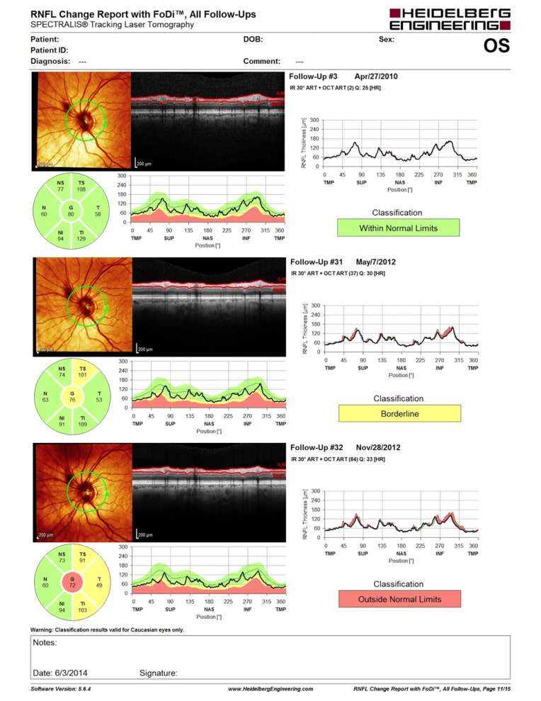 The Use of Spectral-Domain Optical Coherence Tomography to Detect Glaucoma Progression.