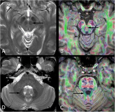 Behavioral disorders and cognitive impairment associated with cerebellar lesions.