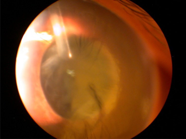 A Surgical Approach to Pediatric Glaucoma.