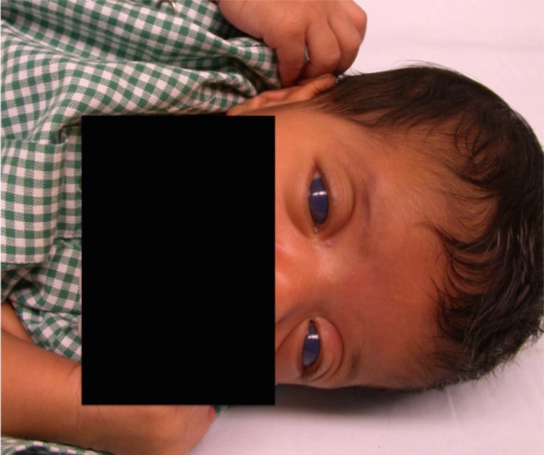 A Surgical Approach to Pediatric Glaucoma.