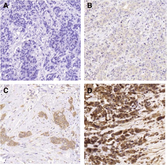 Tumor-specific expression of HMG-CoA reductase in a population-based cohort of breast cancer patients.