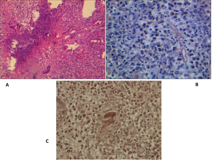 Fungal Orbital Infection Mimicking Malignancy in a Girl.