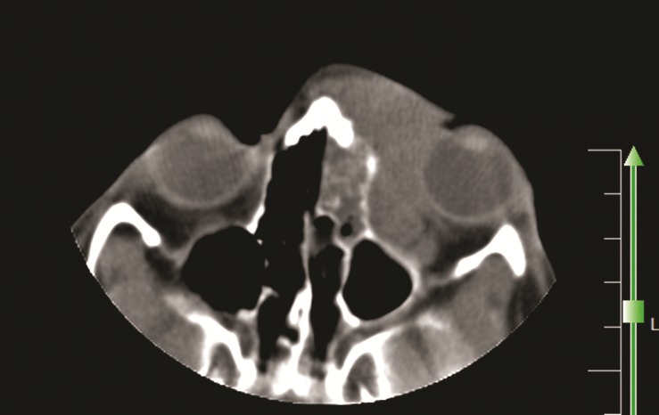 Fungal Orbital Infection Mimicking Malignancy in a Girl.