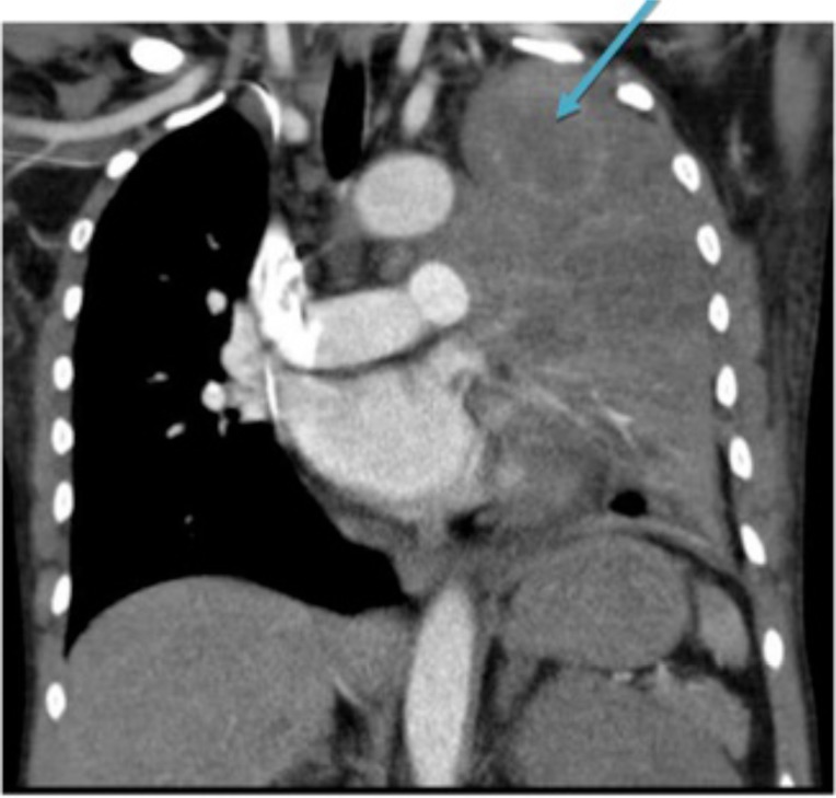 An Unusual Mimicker of Systemic Lupus Erythematosus: A Case Report.