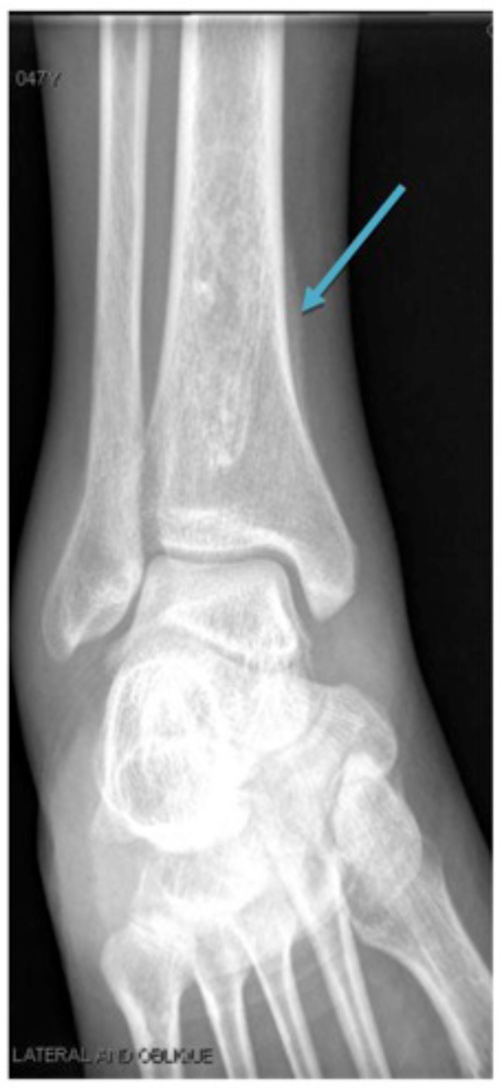An Unusual Mimicker of Systemic Lupus Erythematosus: A Case Report.