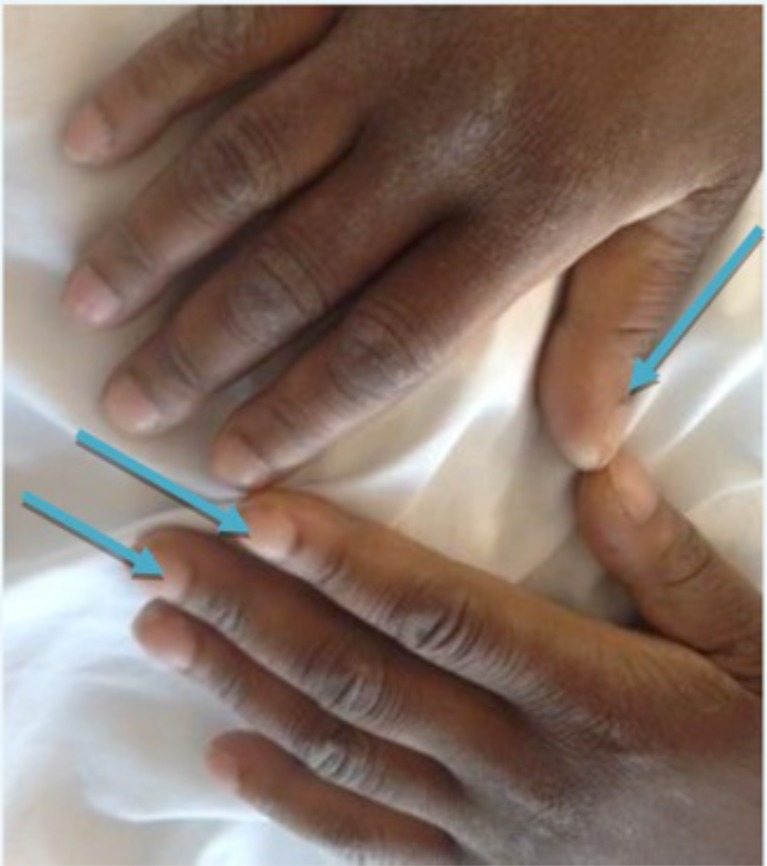 An Unusual Mimicker of Systemic Lupus Erythematosus: A Case Report.