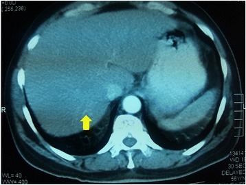 Solitary scalp metastasis - a rare presentation of hepatocellular carcinoma.