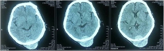 Solitary scalp metastasis - a rare presentation of hepatocellular carcinoma.