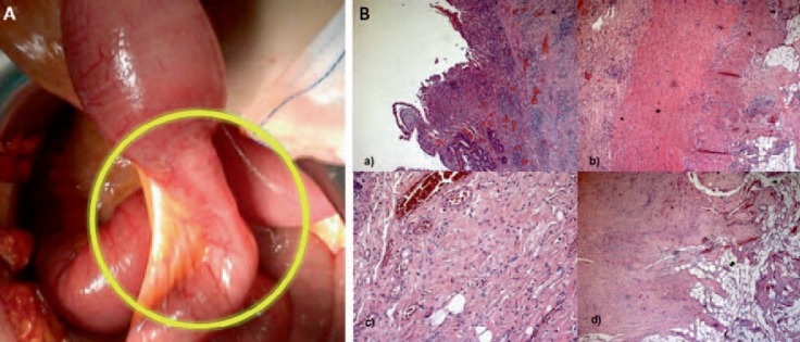 Intestinal Stenosis of Garré: An Old Problem Revisited.