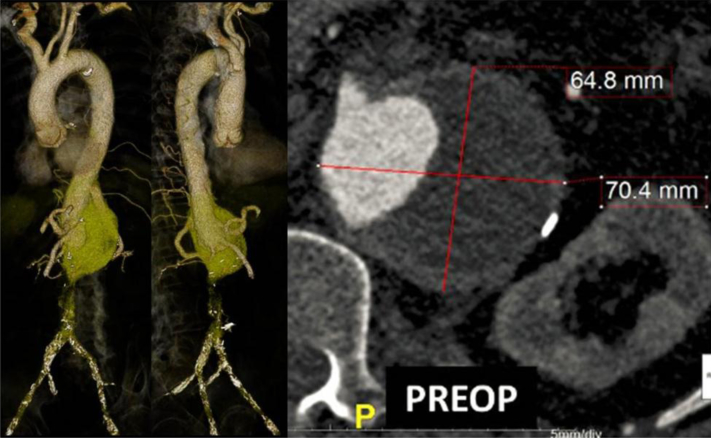 Branched endograft repair of an aortic stump aneurysm