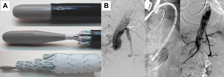 Branched endograft repair of an aortic stump aneurysm