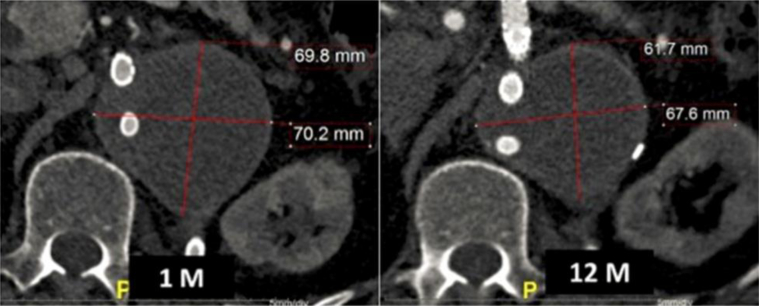 Branched endograft repair of an aortic stump aneurysm