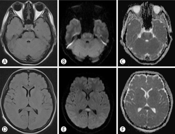 A Case of Osmotic Demyelination Presenting with Severe Hypernatremia.