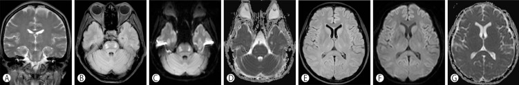 A Case of Osmotic Demyelination Presenting with Severe Hypernatremia.