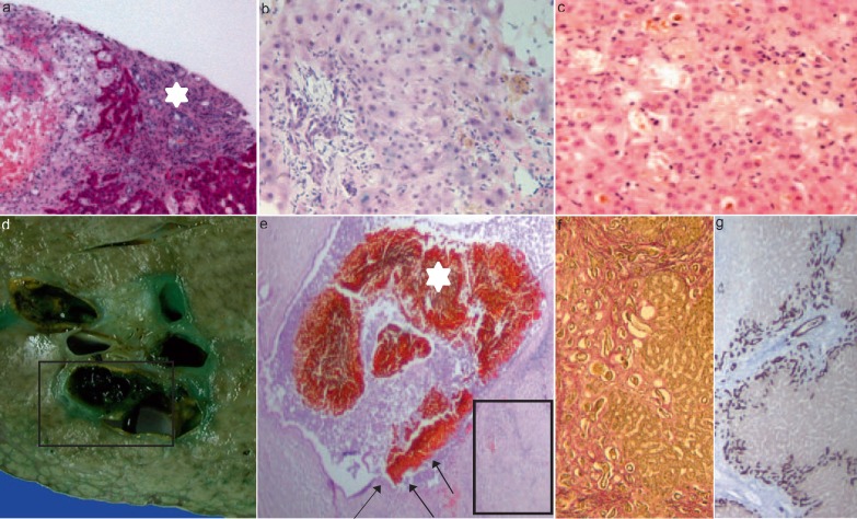 Update on Sclerosing Cholangitis in Critically Ill Patients.