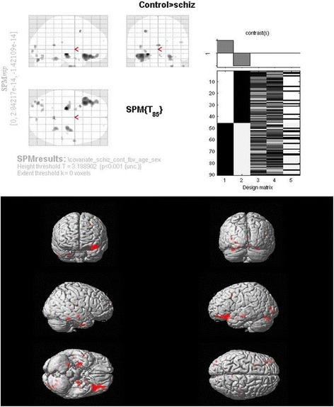 A systematic examination of brain volumetric abnormalities in recent-onset schizophrenia using voxel-based, surface-based and region-of-interest-based morphometric analyses.