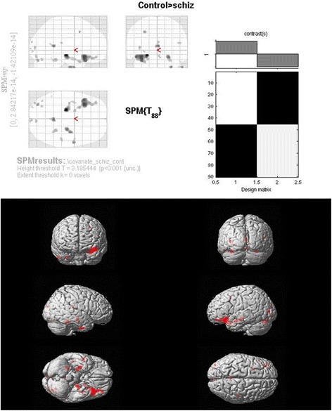 A systematic examination of brain volumetric abnormalities in recent-onset schizophrenia using voxel-based, surface-based and region-of-interest-based morphometric analyses.