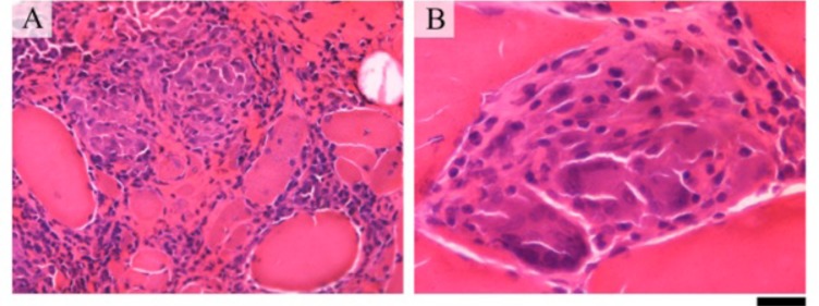 LETTER TO THE EDITOR Atypical Granulomatous Myositis and Pulmonary Sarcoidosis.