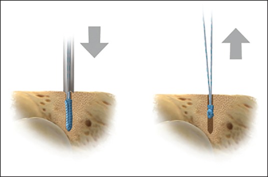 Triple labrum tears repaired with the JuggerKnot™ soft anchor: Technique and results.