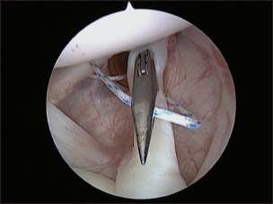 Triple labrum tears repaired with the JuggerKnot™ soft anchor: Technique and results.