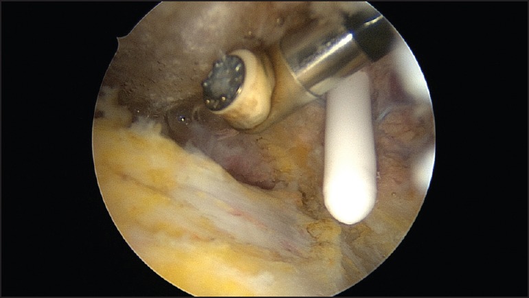 Warm irrigation fluid does not raise the subacromial temperature to harmful levels while using radiofrequency device.