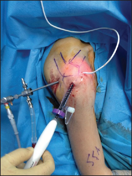 Warm irrigation fluid does not raise the subacromial temperature to harmful levels while using radiofrequency device.