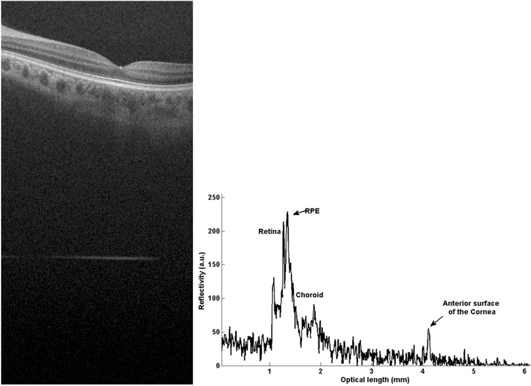 Geographic mapping of choroidal thickness in myopic eyes using 1050-nm spectral domain optical coherence tomography.