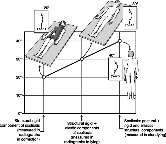 Scoliosis-Specific exercises can reduce the progression of severe curves in adult idiopathic scoliosis: a long-term cohort study.