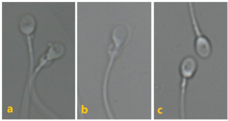 Large nuclear vacuoles in spermatozoa negatively affect pregnancy rate in IVF cycles.