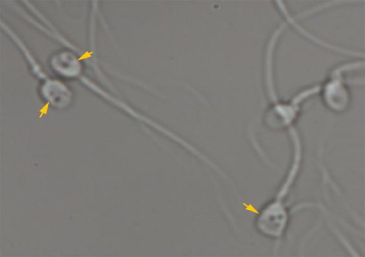 Large nuclear vacuoles in spermatozoa negatively affect pregnancy rate in IVF cycles.