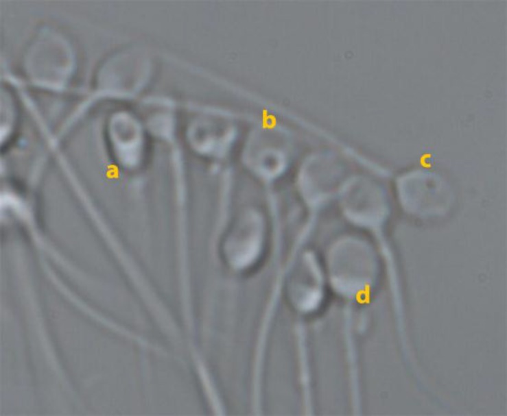 Large nuclear vacuoles in spermatozoa negatively affect pregnancy rate in IVF cycles.