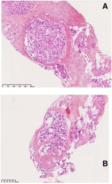 Very late recurrence of Diethylstilbestrol - related clear cell carcinoma of the cervix: case report.