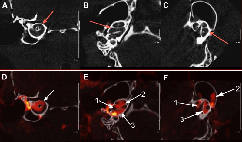 Experimental Fusion of Contrast Enhanced High-Field Magnetic Resonance Imaging and High-Resolution Micro-Computed Tomography in Imaging the Mouse Inner Ear.