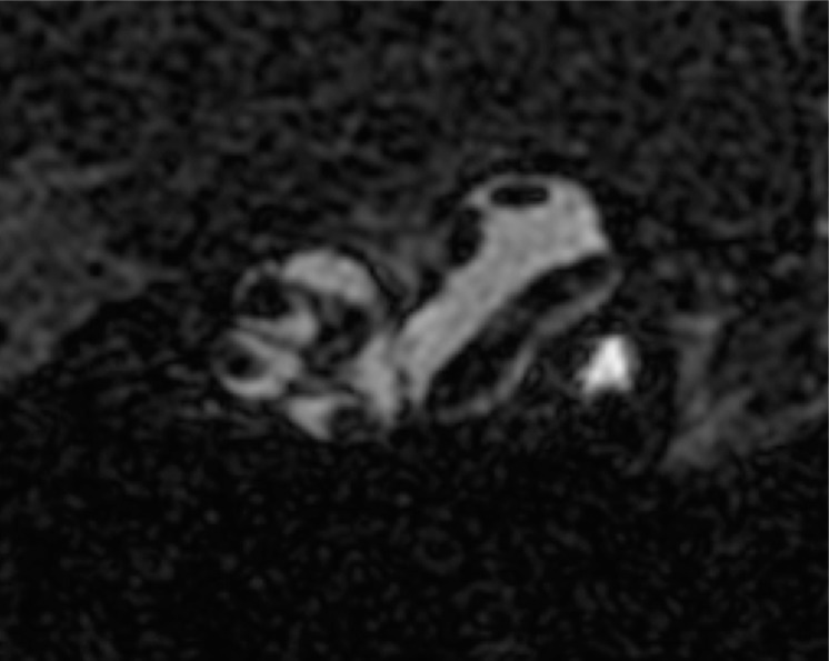 Experimental Fusion of Contrast Enhanced High-Field Magnetic Resonance Imaging and High-Resolution Micro-Computed Tomography in Imaging the Mouse Inner Ear.