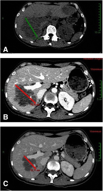 Very late recurrence of Diethylstilbestrol - related clear cell carcinoma of the cervix: case report.