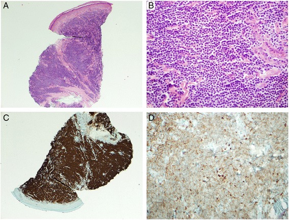 Small lymphocytic lymphoma with florid perniosis-like features: a case report.