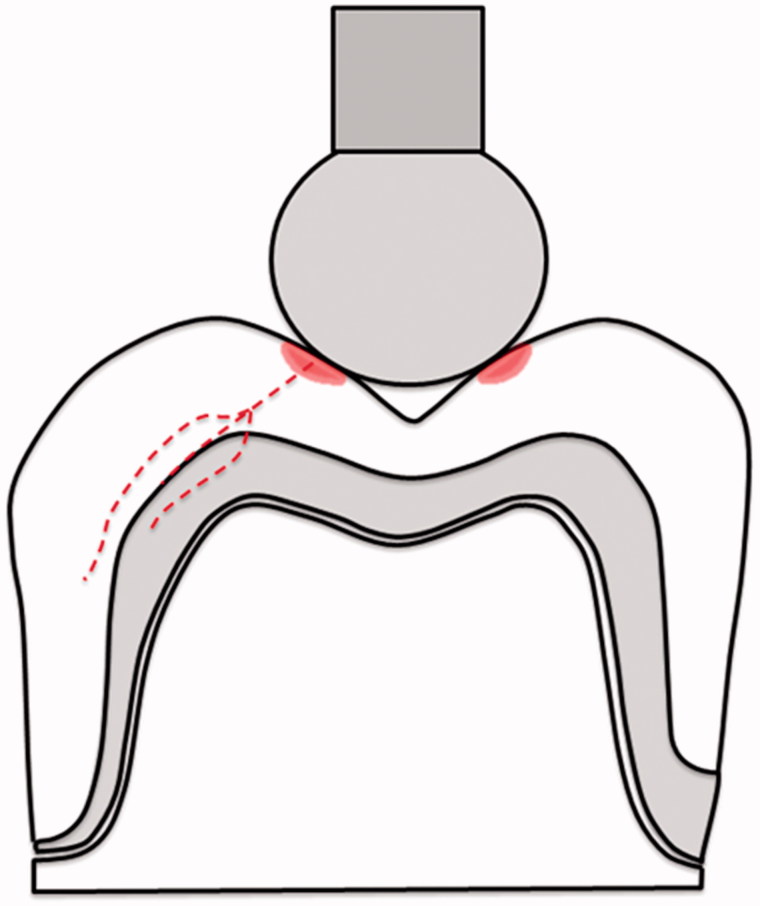 Fracture of porcelain-veneered gold-alloy and zirconia molar crowns using a modified test set-up.