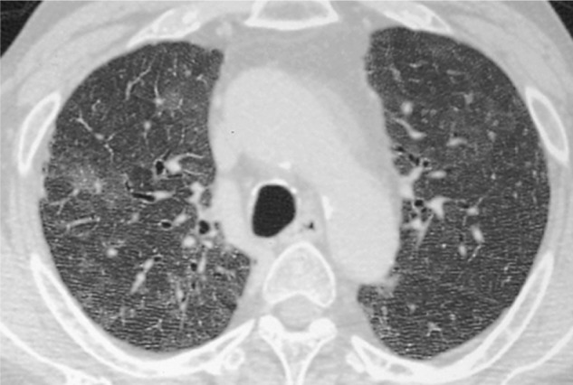 Pneumocystis Pneumonia in Human Immunodeficiency Virus-infected Adults and Adolescents: Current Concepts and Future Directions.