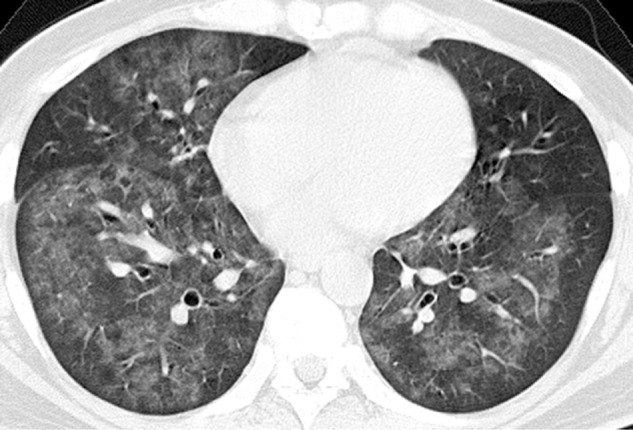 Pneumocystis Pneumonia in Human Immunodeficiency Virus-infected Adults and Adolescents: Current Concepts and Future Directions.