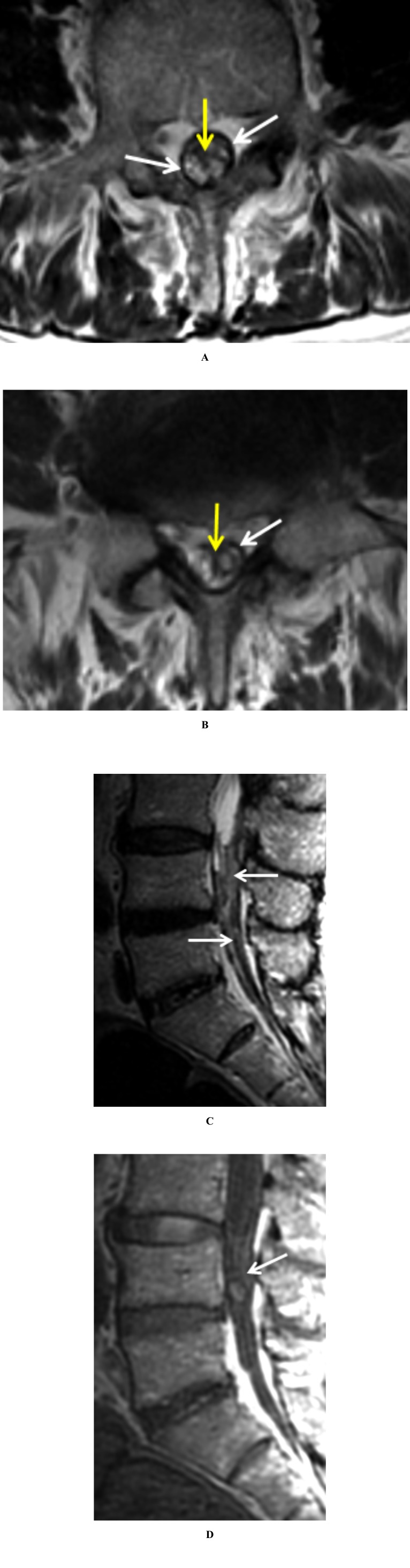 Arachnoiditis Ossificans - A Rare Cause of Progressive Myelopathy.