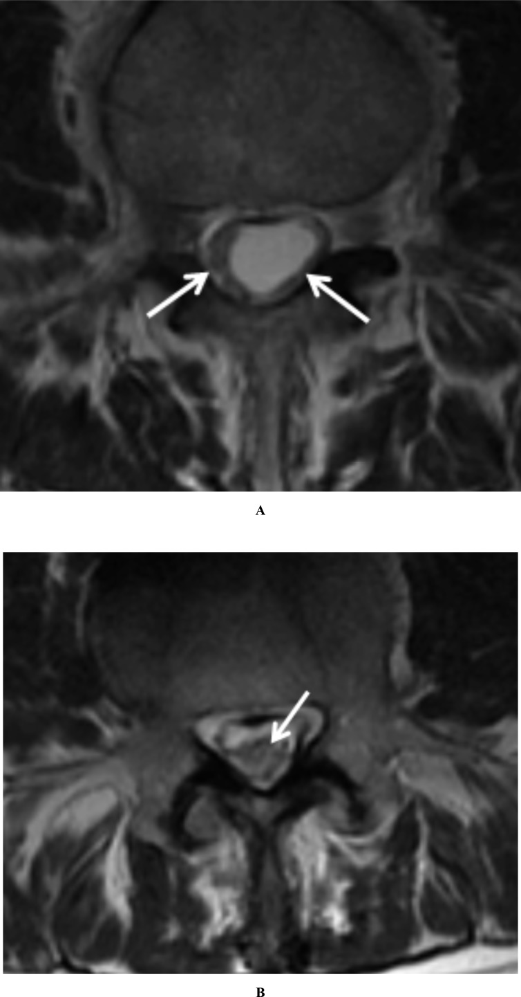 Arachnoiditis Ossificans - A Rare Cause of Progressive Myelopathy.