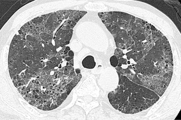 Pneumocystis Pneumonia in Human Immunodeficiency Virus-infected Adults and Adolescents: Current Concepts and Future Directions.