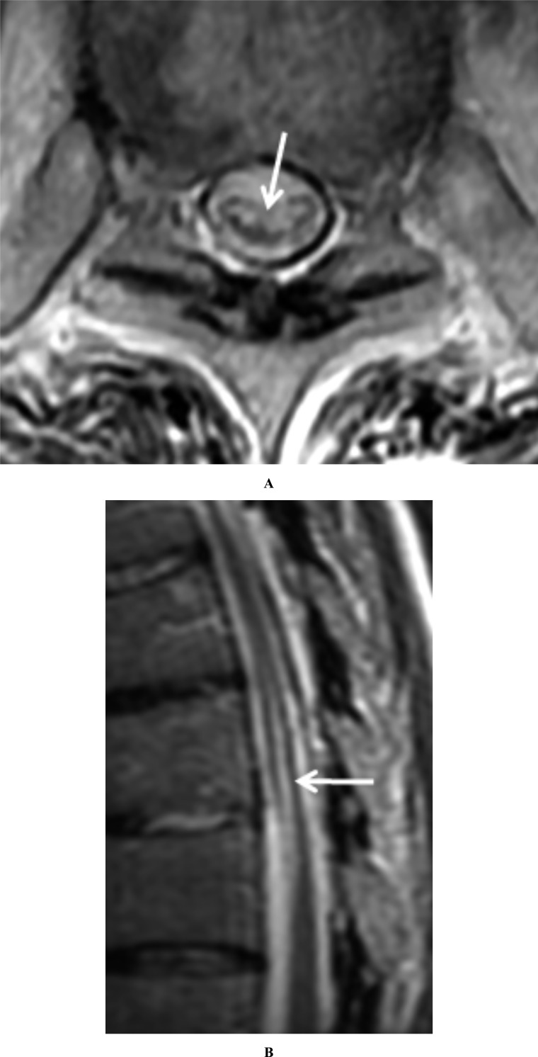 Arachnoiditis Ossificans - A Rare Cause of Progressive Myelopathy.